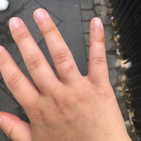 ........ - (Krankheit, Hand, gelb)