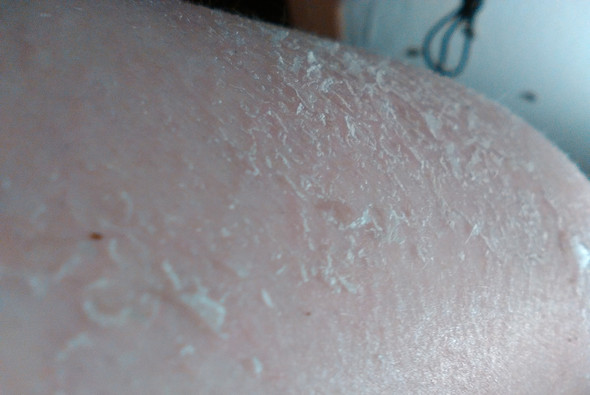 Haut schält sich