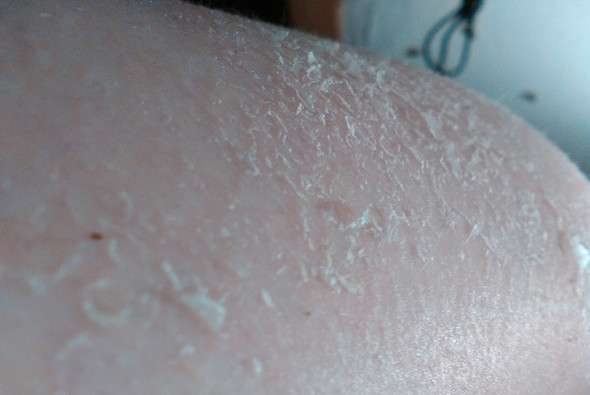 Kann Mir Vielleicht Jemand Sagen Ob Er Das Problem Kennt Haut Am Oberarm Pellt Sich Juckt Wie Holle Es Ist Mitten Im Winter Und Ich Habe Keinen Sonnenbrand Schuppen Kann Mir Vielleicht Jemand Sagen Ob Er Das Problem Kennt Haut Am Oberarm Pellt Sich Juckt Wie Holle Es Ist Mitten Im Winter Und Ich Habe Keinen Sonnenbrand Schuppen