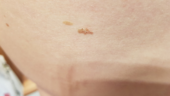 Kann Sich Ein Muttermal Ablosen Oder Ist Das Hautkrebs Gesundheit Und Medizin Haut Hautprobleme Kann Sich Ein Muttermal Ablosen Oder Ist Das Hautkrebs Gesundheit Und Medizin Haut Hautprobleme