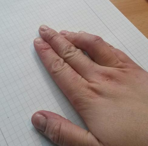 Kapselriss Im Finger Oder Bruch Wie Lange Bleibt Der Finger Krumm Verletzung Kapselriss Kapselriss Im Finger Oder Bruch Wie Lange Bleibt Der Finger Krumm Verletzung Kapselriss