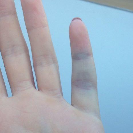 Blauer Finger  - (Finger, Bruch, Trauma)