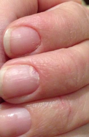 mein nagel - (Haut, Fingernägel, Neurodermitis)
