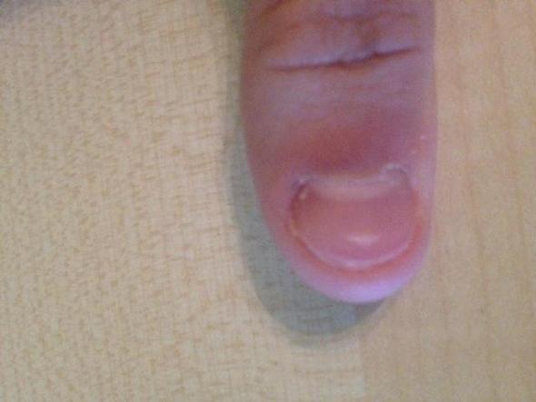 Finger mit Kaputten Nagel und kaputter Nagelhaut - (Haut, Kosmetik, Nägel)