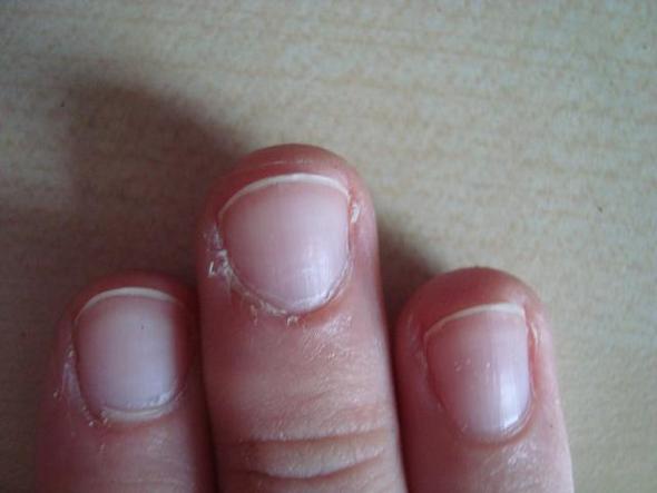 Kaputte Nagelhaut Kosmetik Finger Trocken