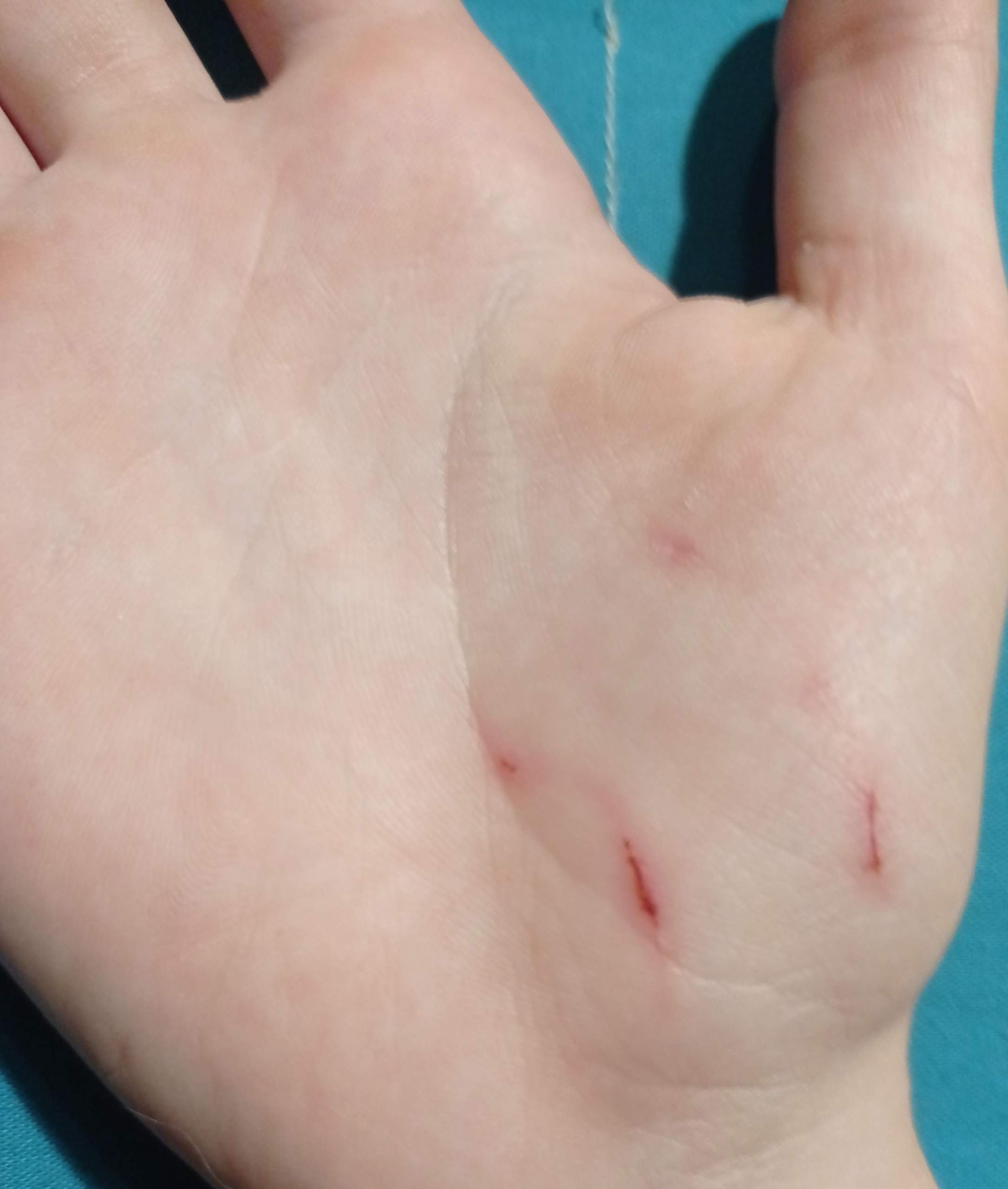 Katzenbiss? (Katze, Infektion, Blutvergiftung)