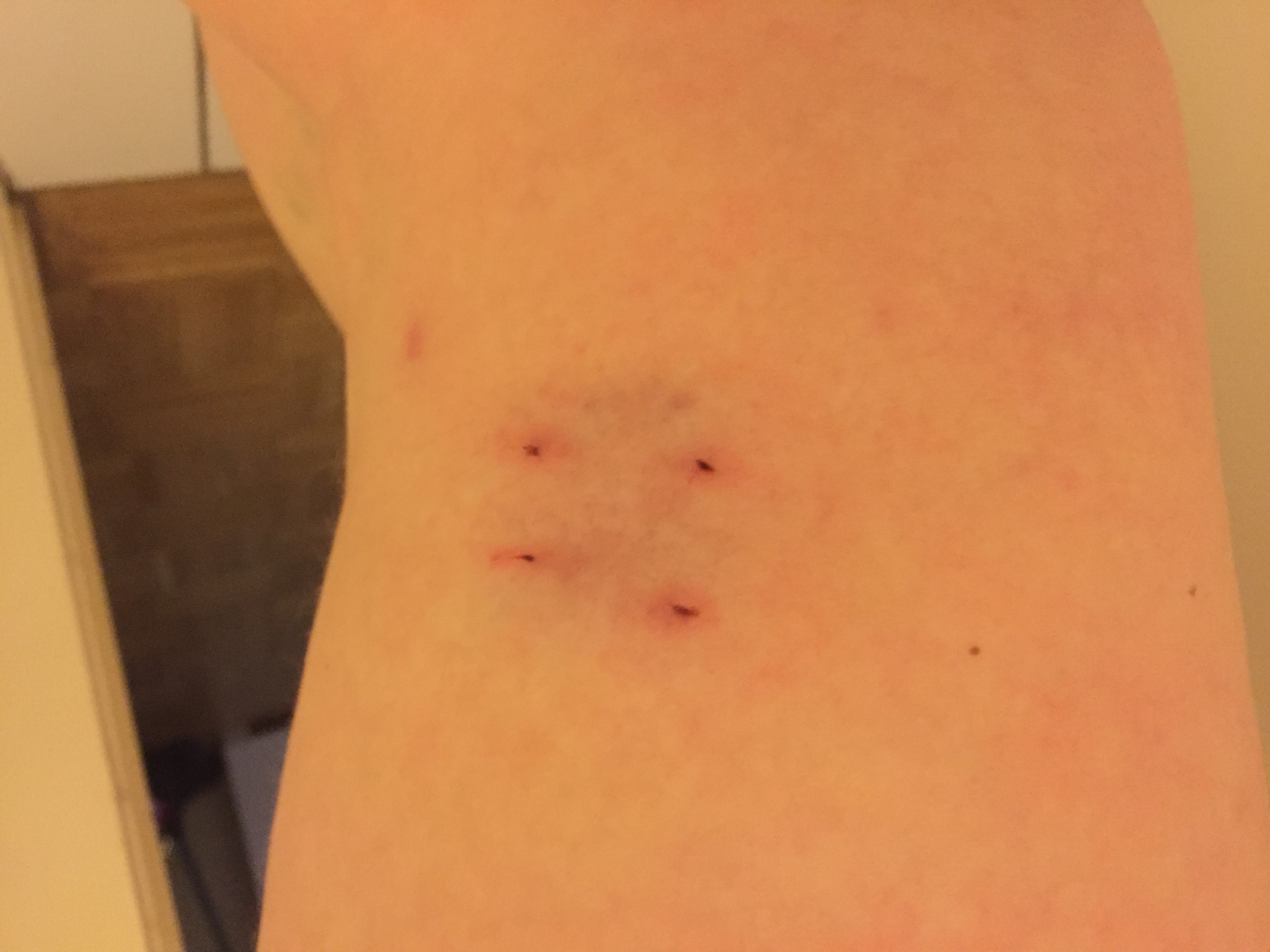 Katzenbiss, gleich zum Arzt oder übertrieben? (Katzen, Biss)