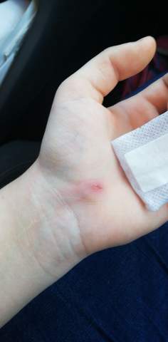 Katzenbiss Verandert Gesundheit Und Medizin Gesundheit Tiere Katzenbiss Verandert Gesundheit Und Medizin Gesundheit Tiere