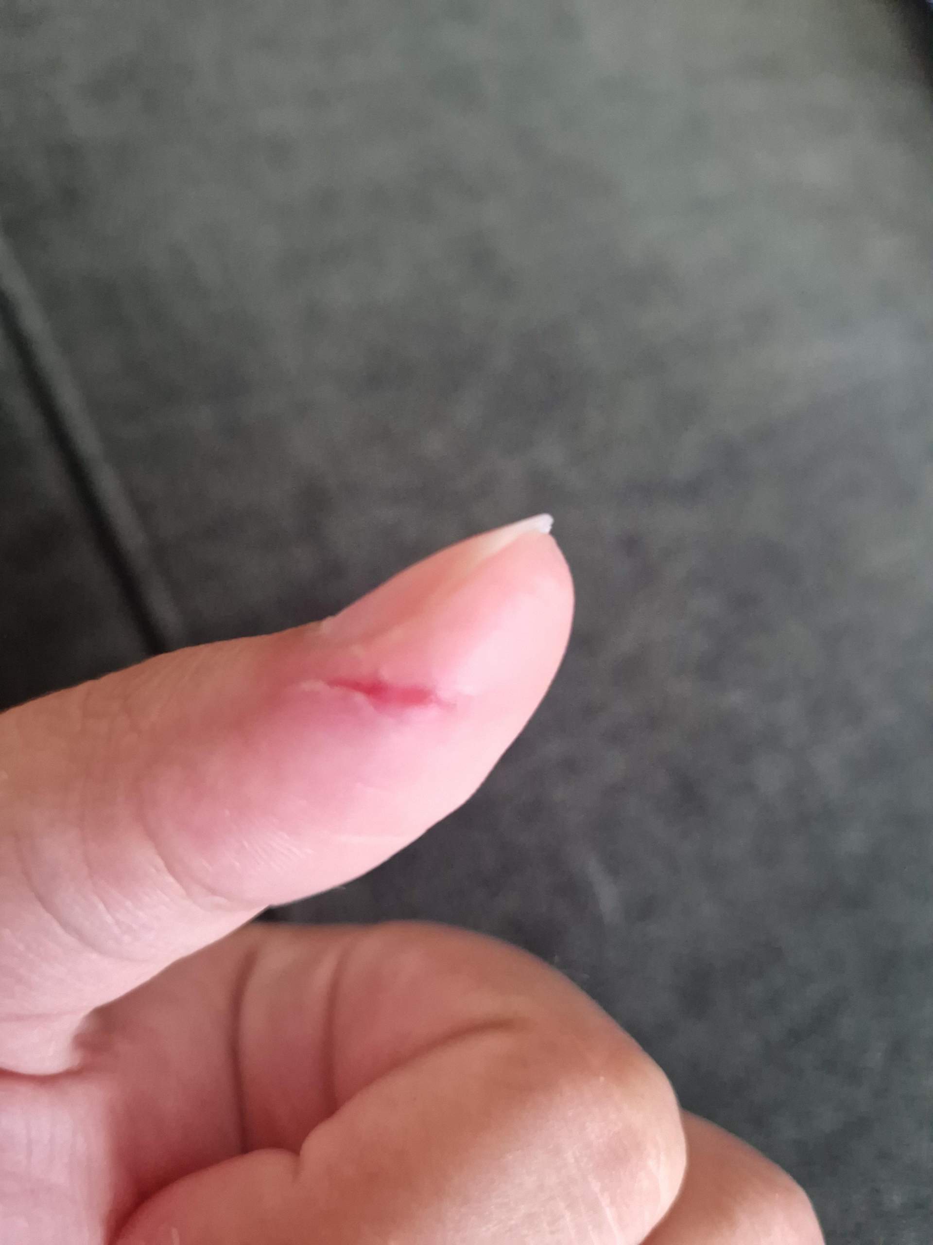 Katze Hat Mich Gekratzt Und Jetzt Schwellung Katzenkratzer entzündet? (Entzündung, Kratzer)