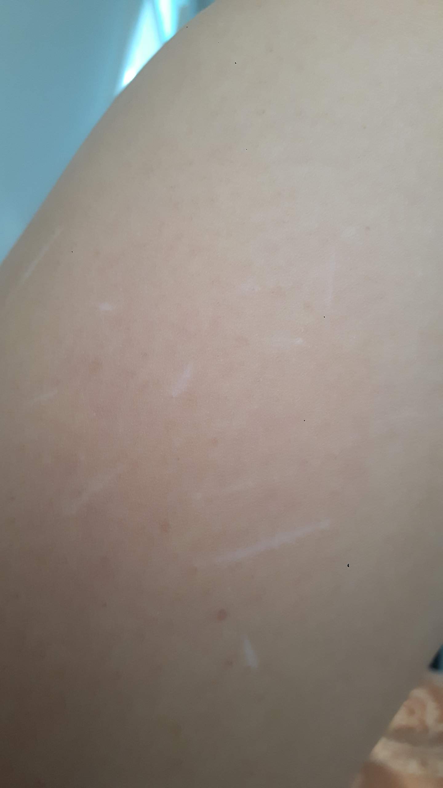 Katze Hat Mich Gekratzt Und Jetzt Schwellung Narben wegen Katze loswerden? (Gesundheit und Medizin, Gesundheit, Medizin)