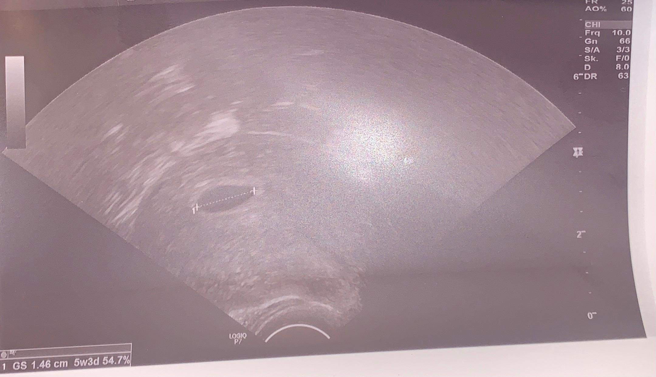 7 Ssw Kein Embryo Zu Sehen Aber Dottersack Kein Dottersack und Embryo? (Gesundheit und Medizin, Schwangerschaft