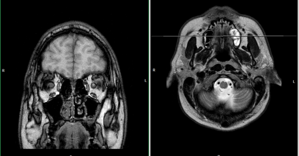 MRT Bild vom Kopf  - (Arzt, Krankheit, Verletzung)