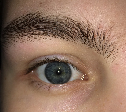 Keine Wimpern Mehr Was Soll Ich Tun Krankheit Augen