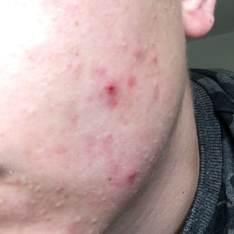 so sieht es momentan aus - (Medizin, Pickel, isotretinoinum)