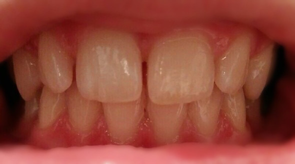 Meine Zähne - (Zähne, Zahnspange)