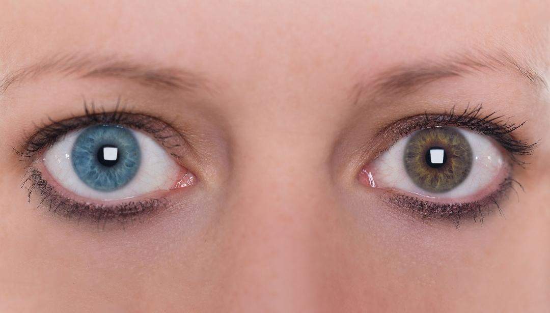 Kennt ihr jemanden, der Heterochromie hat (zwei unterschiedlich farbige ...