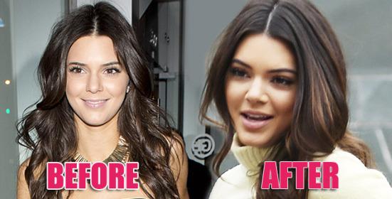 Kendall Jenners Nose Job - (Gesundheit, Körper, Schönheit)