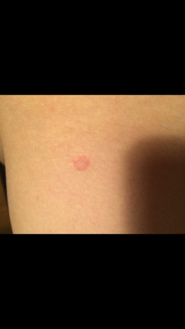 Kennt Sich Hier Jemand Mit Syphilis Aus Wie Hoch Ist Das Risiko Bei Zungenkussen Gesundheit Und Medizin Sex Geschlechtskrankheiten