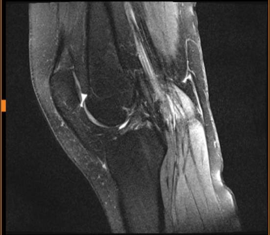 Kennt sich jemand mit MRT-Bildern aus - Knie?