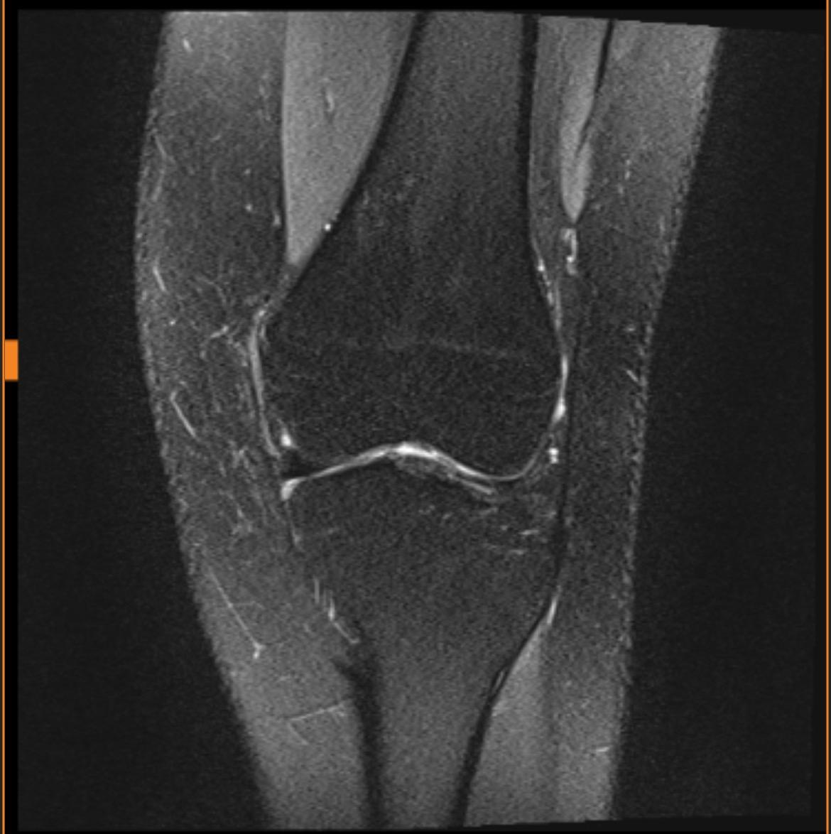 Kennt sich jemand mit MRTBildern aus Knie? (Gesundheit und Medizin Kennt sich jemand mit MRTBildern aus Knie? (Gesundheit und Medizin