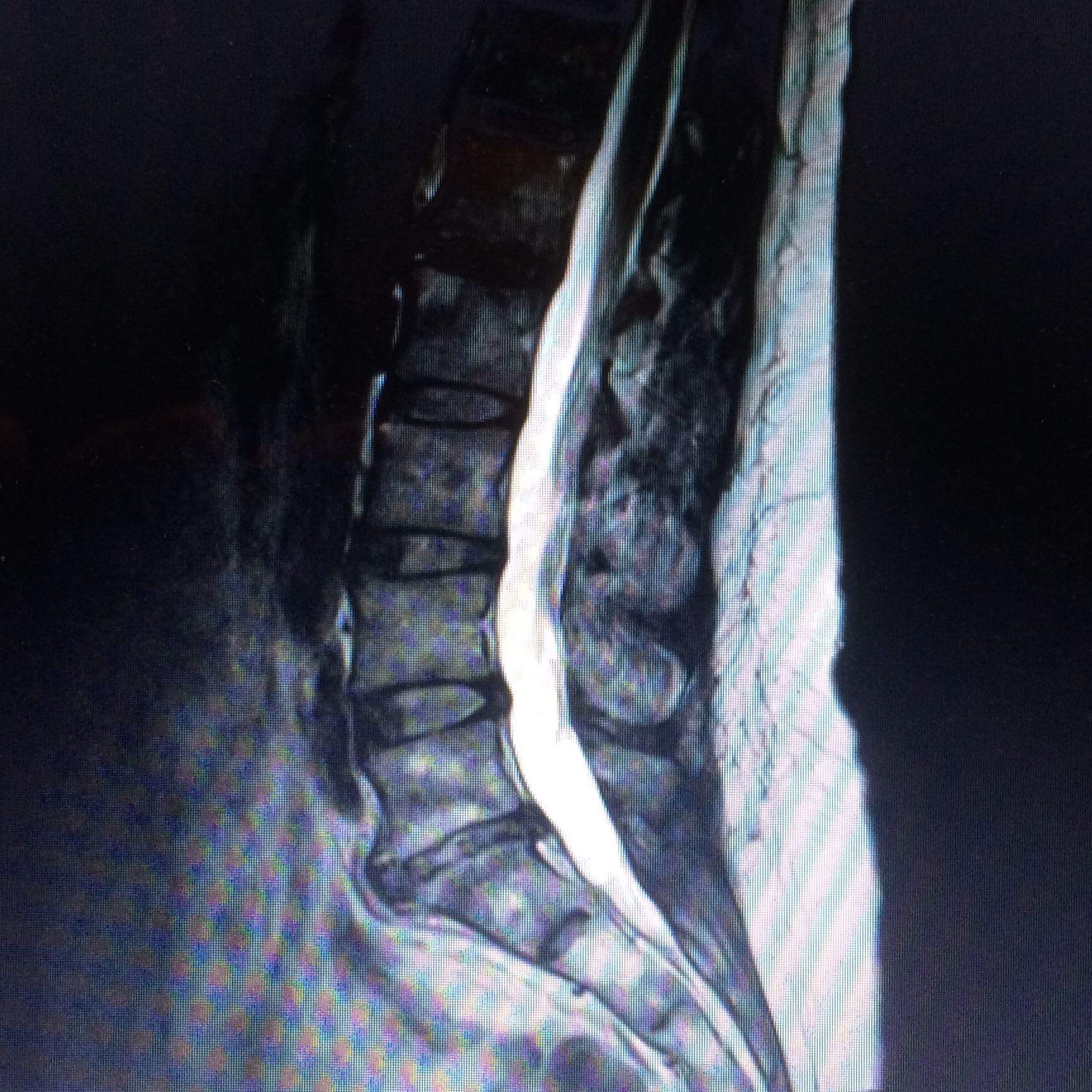 Kennt sich jemand mit MRT Bildern aus? (Bandscheibenvorfall) Kennt sich jemand mit MRT Bildern aus? (Bandscheibenvorfall)