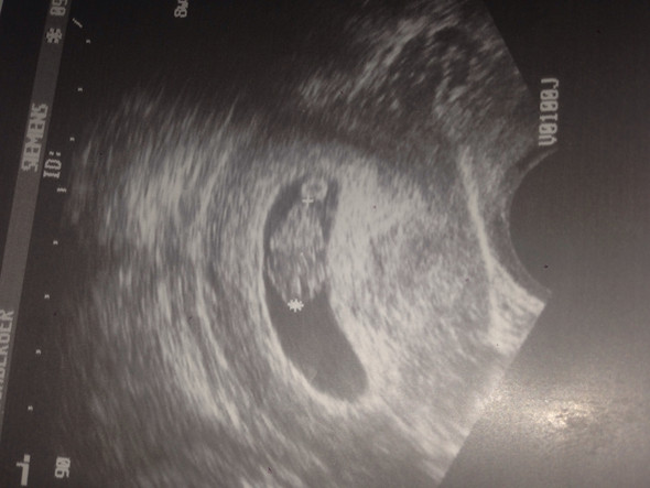 Ultraschallbild  - (schwanger, ultraschallbild)