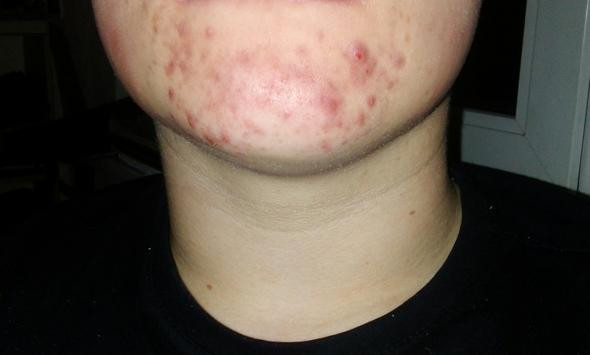 Kinn Ist Rot Mit Pickeln Was Tun Mit Bild Pickel