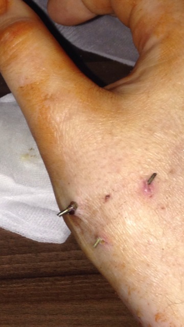 Kirschnerdrähte unter Gips? (Arzt, Operation, Bruch)