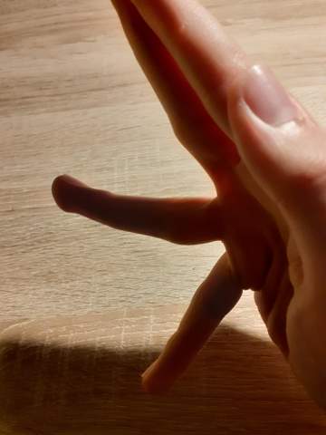 Kleiner finger zeigefinger Geschwollener, entzündeter