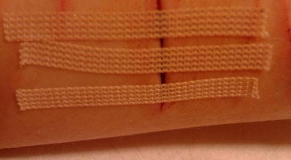 Klammerpflaster Duschen Wunde Pflaster Abdecken Klammerpflaster Duschen Wunde Pflaster Abdecken