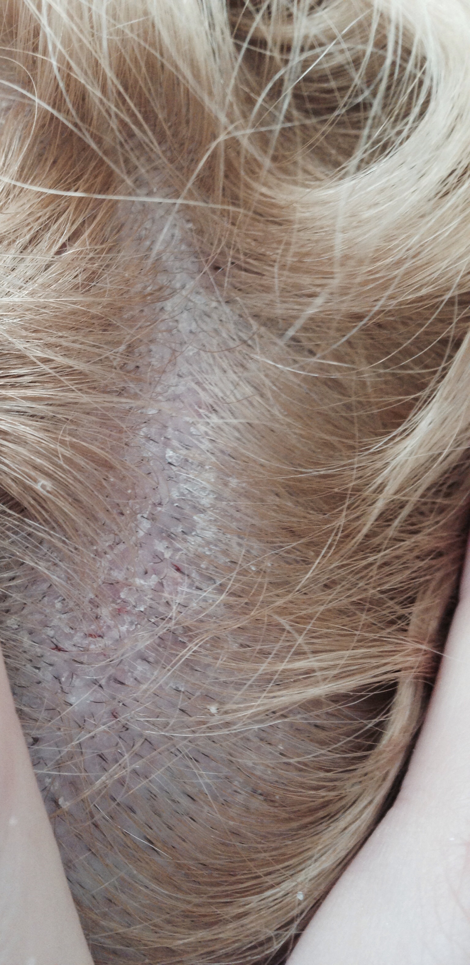 Klebrige Stellen/Schuppen auf der Kopfhaut