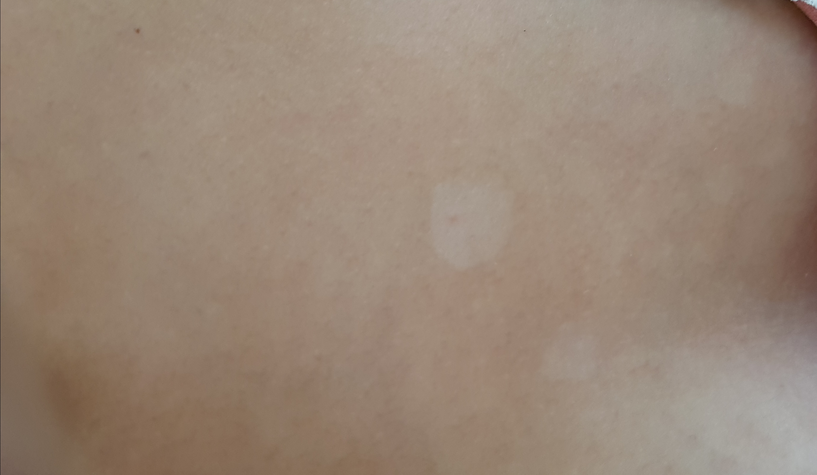 Kleienpilzflechte auf der Brust verfärbt sich, schlecht? (Gesundheit und Medizin, Mädchen, Frauen)