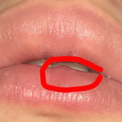 Kleine Beule Auf Der Kippe Gesundheit Und Medizin Arzt Lippe Kleine Beule Auf Der Kippe Gesundheit Und Medizin Arzt Lippe