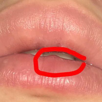 Kleine Beule auf der Kippe? (Gesundheit und Medizin, Arzt Kleine Beule auf der Kippe? (Gesundheit und Medizin, Arzt