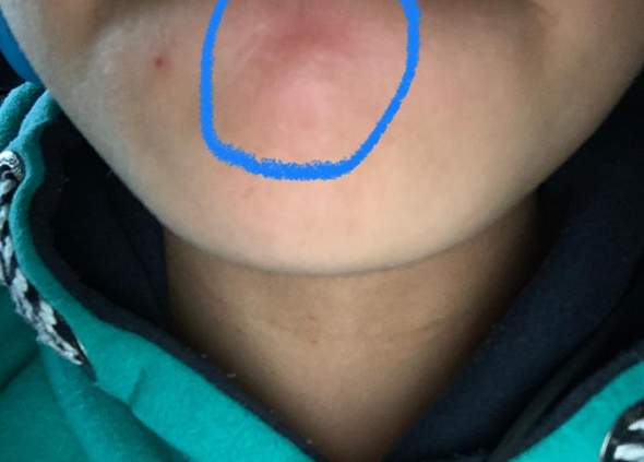 Kleine Beule Knubbel Unter Der Lippe Gesundheit Und Medizin Kleine Beule Knubbel Unter Der Lippe Gesundheit Und Medizin