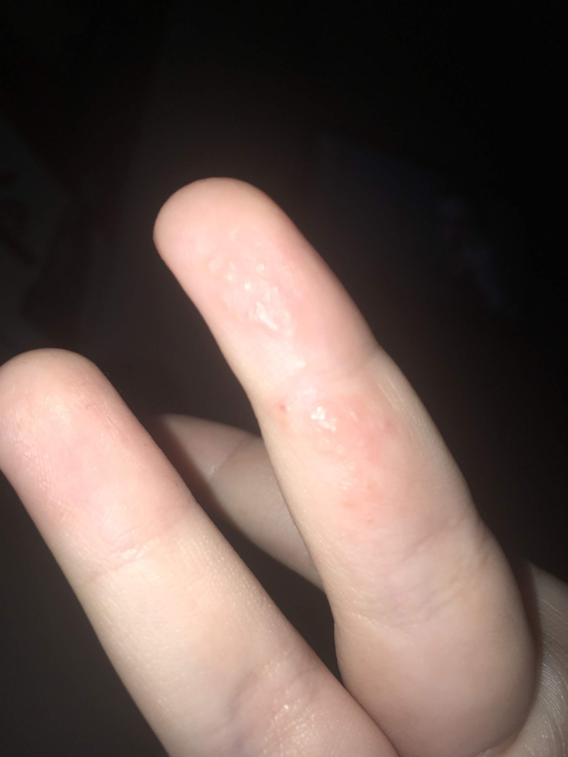 Kleine Blaschen Am Finger Gesundheit Und Medizin Gesundheit Haut Kleine Blaschen Am Finger Gesundheit Und Medizin Gesundheit Haut