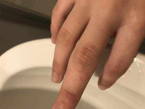 Kleine Blaschen Am Finger Gesundheit Und Medizin Gesundheit Kleine Blaschen Am Finger Gesundheit Und Medizin Gesundheit