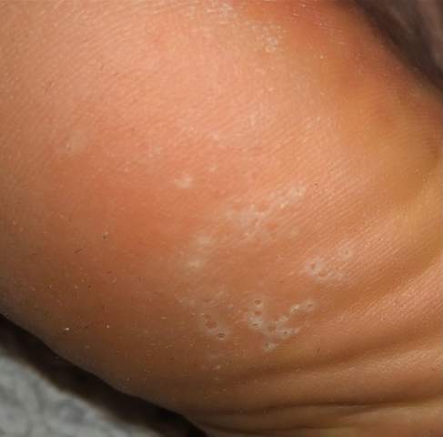 Kleine Blaschen An Den Fussen Gesundheit Und Medizin Fusse Kleine Blaschen An Den Fussen Gesundheit Und Medizin Fusse