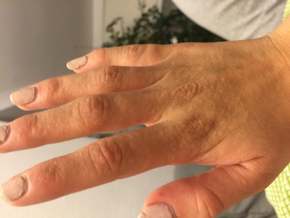 Kleine Blaschen An Den Handen Die Jucken Medizin Haut Hand Kleine Blaschen An Den Handen Die Jucken Medizin Haut Hand
