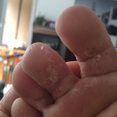 Kleine Blaschen An Hand Und Fuss Korper Haut Fusse Kleine Blaschen An Hand Und Fuss Korper Haut Fusse