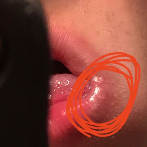 Kleine Blaschen Auf Den Lippen Herpes Gesundheit Und Medizin Krankheit Kleine Blaschen Auf Den Lippen Herpes Gesundheit Und Medizin Krankheit