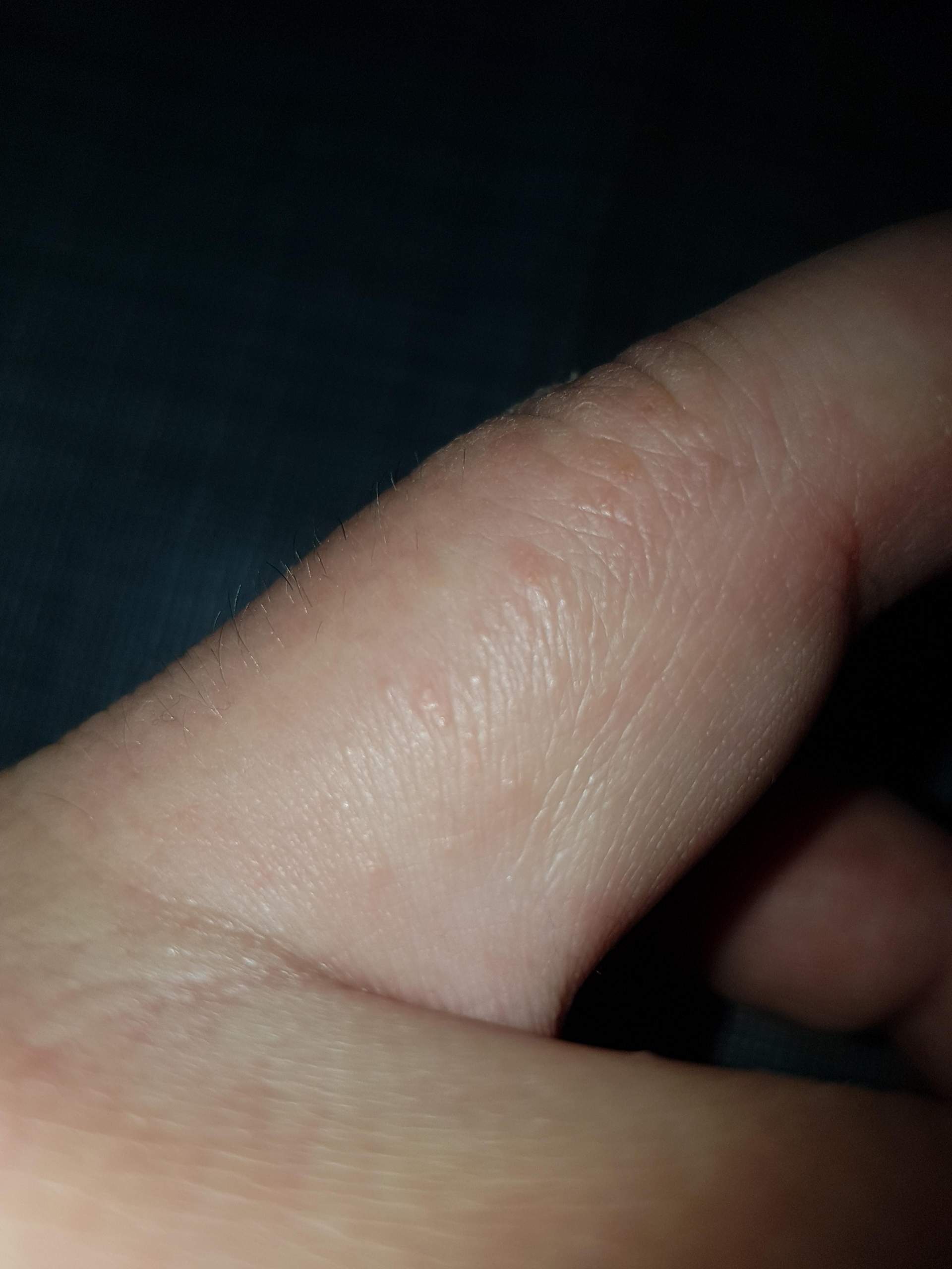 Kleine Blasen an den Fingern? (Gesundheit und Medizin, Hautpilzkrankheit)