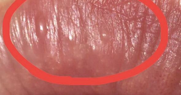 Bitte Hilfe Kleine Blasen Auf Lippe Was Tun Blase Angeschwollen Bitte Hilfe Kleine Blasen Auf Lippe Was Tun Blase Angeschwollen