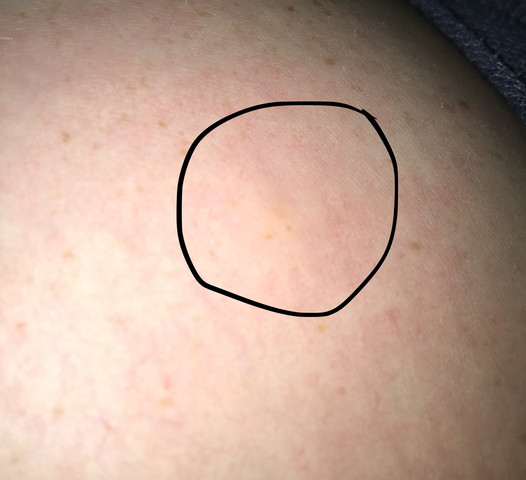 Kleine Einzelne Stiche Am Korper Nur Abends Nachts Was Ist Das Gesundheit Und Medizin Schlafen Allergie Kleine Einzelne Stiche Am Korper Nur Abends Nachts Was Ist Das Gesundheit Und Medizin Schlafen Allergie