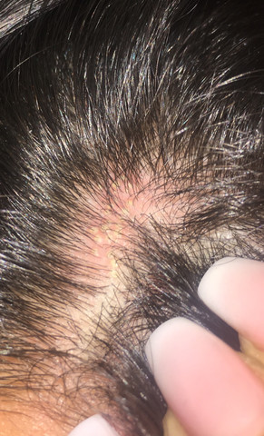 Kleine Eiterpickel Auf Der Kopfhaut Gesundheit Und Medizin Haut Allergie