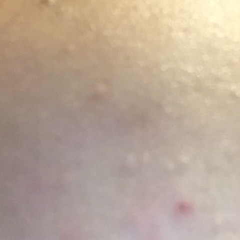 Kleine Farblose Pickel Auf Der Stirn Was Tun Gesundheit Und Medizin Beauty Haut Kleine Farblose Pickel Auf Der Stirn Was Tun Gesundheit Und Medizin Beauty Haut