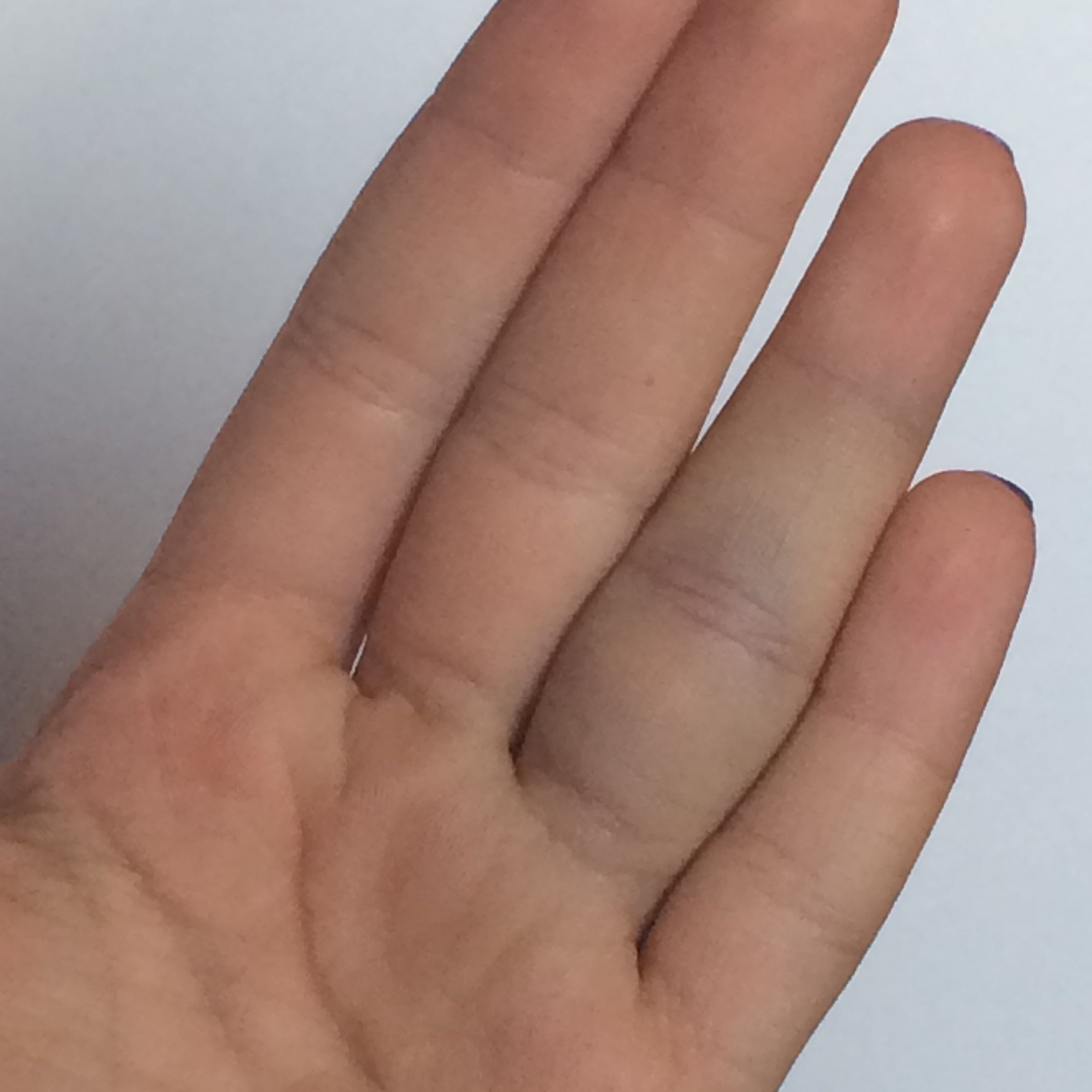 Kleine Frage Arzt ja nein ?? (Verletzung, Finger)