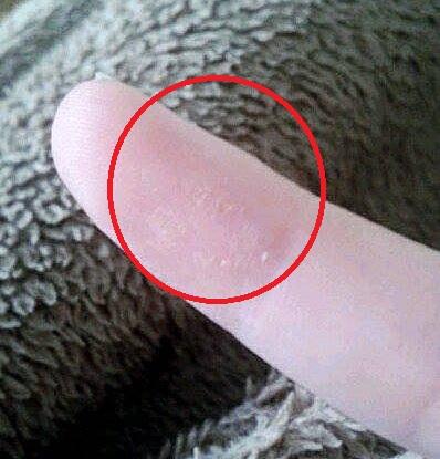 Sonnenallergie Hand Sonnenallergie Hand