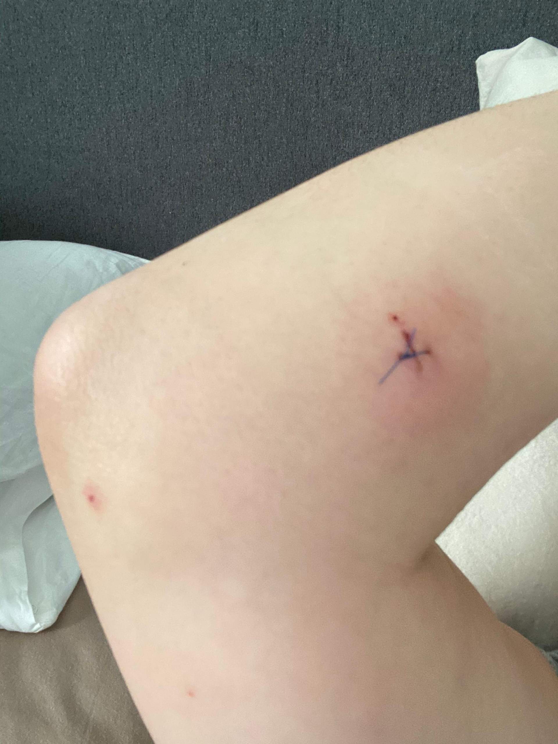 Kleine Genahte Wunde Ist Es Normal Dass Dieser Rote Kreis Entsteht Haut Naht Kleine Genahte Wunde Ist Es Normal Dass Dieser Rote Kreis Entsteht Haut Naht
