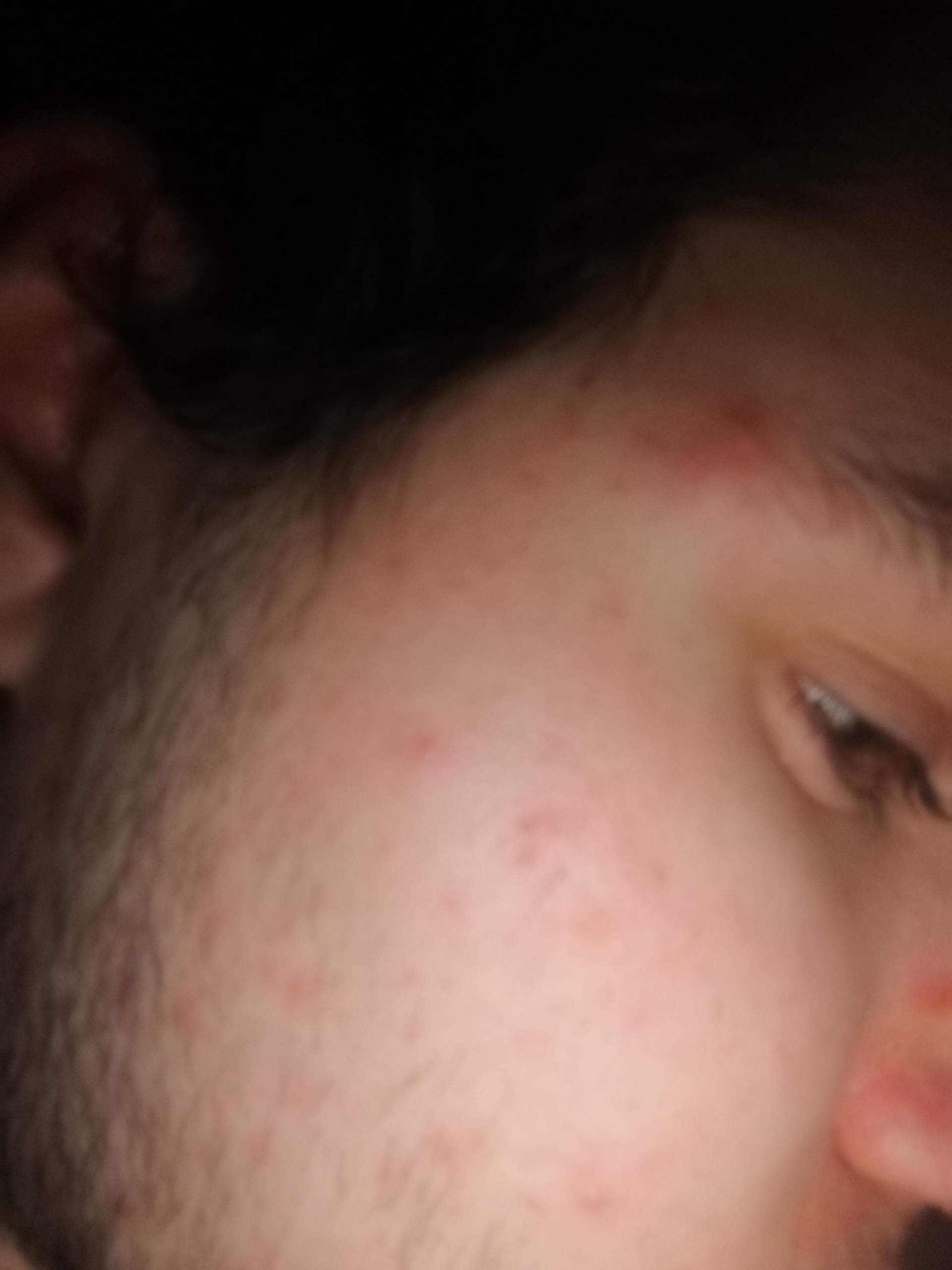Kleine Glatte Beule/Schwellung An der Schläfe/Auge? (Gesundheit und